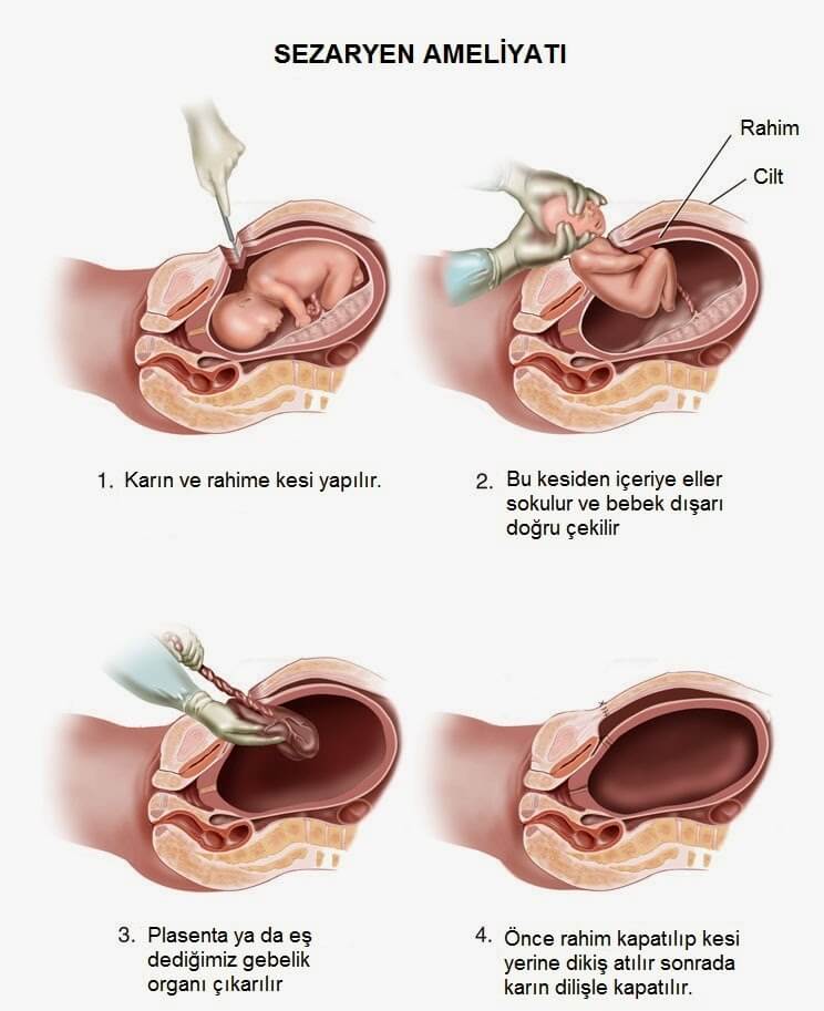 Sezaryen Ameliyat Nedir?