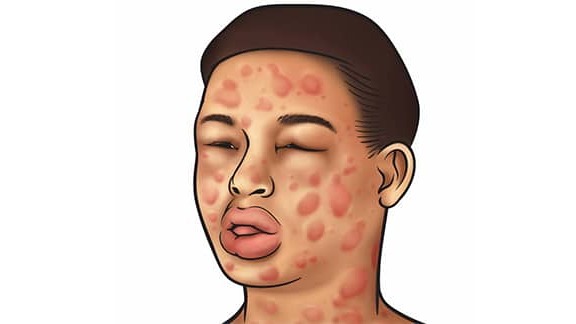 Anafilaksi Nedir? Belirtileri, Nedenleri Nelerdir? Anafilaksi Nedir?