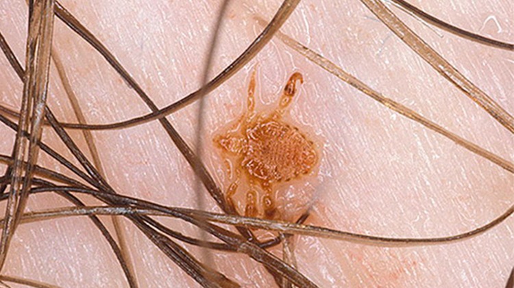 Bit Sorunu: Belirtiler, Korunma Yolları Ve Tedbirler